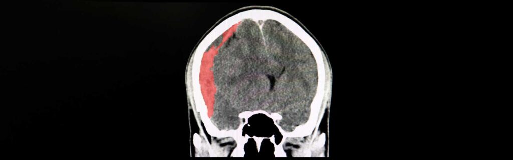 subdural hematoma 101 types, causes and treatment